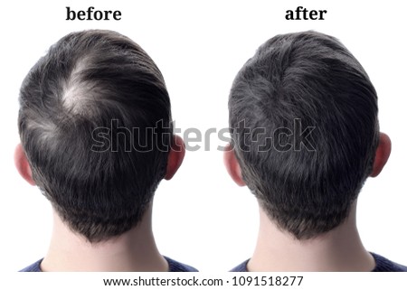 Men'shair after using cosmetic powder for hair thickening. Before and after