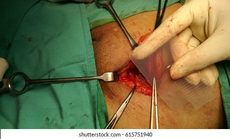 Mesh Application During Inguinal Hernia Repair By Surgeon