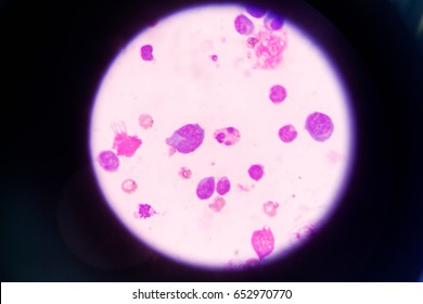 Mesothelial Cell Pleural Fluid Stock Photo 652970770 | Shutterstock