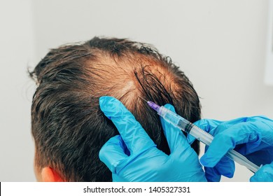 Mesotherapy Of Hair And Head. Injections In The Head. Fighting Hair Loss In Men. Men's Bald Spot In The Center Of The Head At The Crown. The Hands Of The Cosmetologist Trichologist And The Head