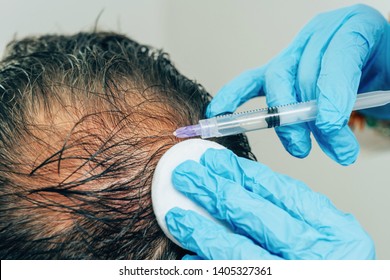 Mesotherapy Of Hair And Head. Injections In The Head. Fighting Hair Loss In Men. Men's Bald Spot In The Center Of The Head At The Crown. The Hands Of The Cosmetologist Trichologist And The Head