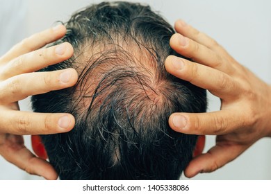 Man Alopecia Areata On Head Spot Stock Photo (Edit Now) 1482069620