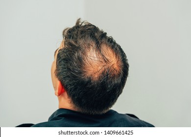 Mesotherapy Of Hair And Head. Traces Of Injections On The Head After Therapy. Male Pattern Baldness. Fighting Hair Loss In Men. Men's Bald Head At The Top.