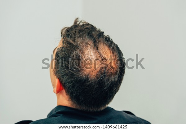 Mesotherapy of hair and head. Traces of\
injections on the head after therapy. Male pattern baldness.\
Fighting hair loss in men. Men\'s bald head at the\
top.