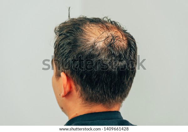 Mesotherapy Hair Head Traces Injections On People Beauty