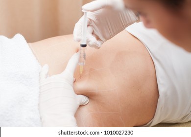 Mesotherapy Treatment On Marked Woman's Body