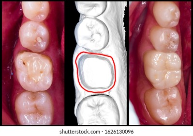 Metal Free Full Anatomy Crown Preparation And Digital Impression Step By Step