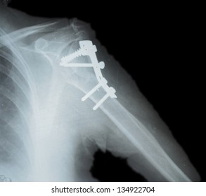 Metal Plate In The Humerus, X-ray