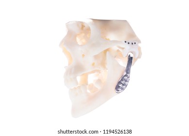 Metal Prosthesis In White 3D Print Skull White Background