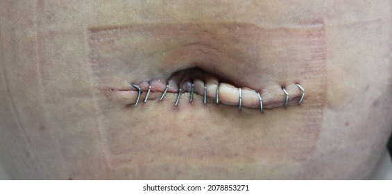 Metal Staples Scar Umbilical Hernia Adult Post Operation