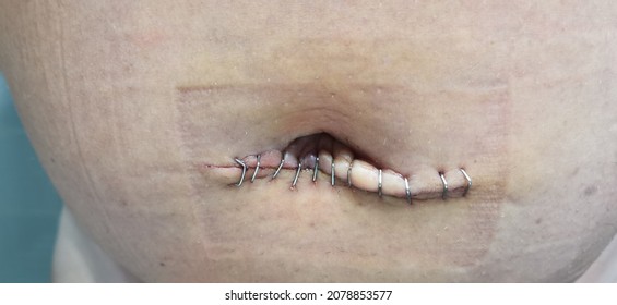 Metal Staples Scar Umbilical Hernia Adult Post Operation