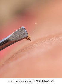 Metal Tweezers Extracts Bee Sting With Insect Venom From Human Skin