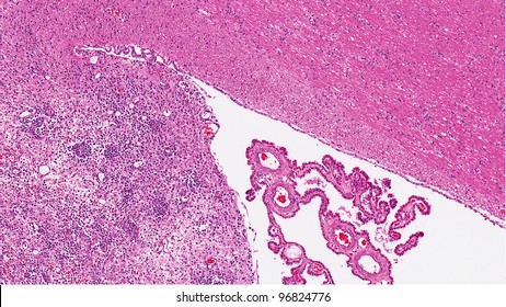 Metastasis Of Lymphoma To The Brain (bottom Left). The Small Blue Tumor Cells Are Clustered Around Blood Vessels. Choroid Plexus (middle) Of The Ventricle And Unaffected Brain (top Right) Are Present