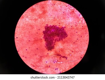 Metastatic Adenocarcinoma Of Lung. Pleural Fluid Cytology Of Lung Papillary Adenocarcinoma, A Type Of Non Small Cell Carcinoma.