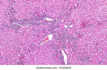 Metastatic Myeloid Leukemia In The Liver. The Metastatic Cancer Cells (small Blue Cells) Are Invading And Replacing Normal Liver Cells.