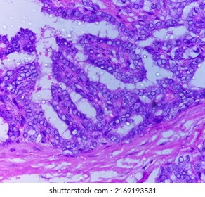 Metastatic Papillary Thyroid Carcinoma (cancer), Central Lymph Node.