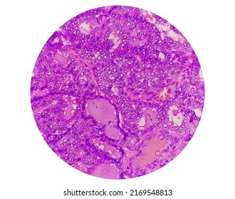 Metastatic Papillary Thyroid Carcinoma (cancer), Central Lymph Node.