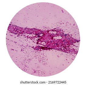 Metastatic Squamous Cell Carcinoma, Cholangiocarcinoma, Adenocarcinoma, Microscopic Show Malignant Tumour Cells, Background Of Cecrotic Debris And Blood, 40x View.