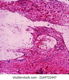 Metastatic Squamous Cell Carcinoma, Cholangiocarcinoma, Adenocarcinoma, Microscopic Show Malignant Tumour Cells, Background Of Cecrotic Debris And Blood, 40x View.