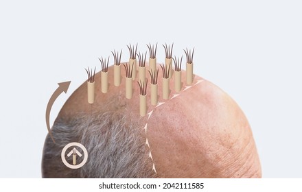 Methods of hair transplantation FUT and FUE fue with transplant as infographic element of illustration. Human alopecia or hair loss problem on adult senior or mature man. Before and after concept
