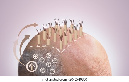 Methods of hair transplantation FUT and FUE fue with transplant as infographic element of illustration. Human alopecia or hair loss problem on adult senior or mature man. Before and after concept - Shutterstock ID 2042949800