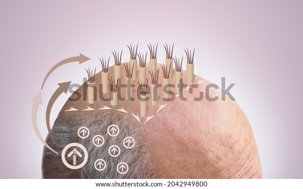 Methods of hair transplantation FUT and FUE fue\
with transplant as infographic element of illustration. Human\
alopecia or hair loss problem on adult senior or mature man. Before\
and after concept