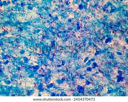 Microbacterium Tuberculosis Bacteria (MTB) analysed by light microscope. AFB stained sputum smear.