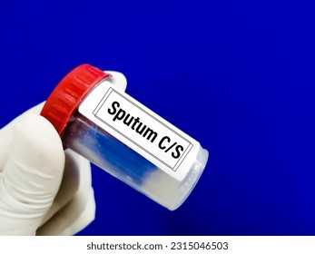 Microbiologist holding sample container with specimen for Sputum Culture test.