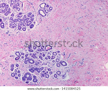 Microglandular adenosis. In this benign condition, the lobules show an increased number of acini of round lumen, which contain eosinophilic secretions, surrounded by a fibrous interlobular stroma. Stock photo © 