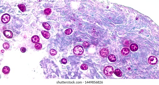 Micrograph of a granuloma containing spherules of Coccidiosis immitis in a patient with  coccidiomycosis, stained with PAS.  This fungus is common in the southwest United States. 