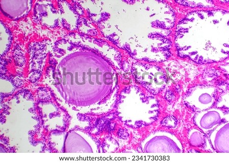 Micrograph of prostatic hyperplasia, showing increased glandular tissue.