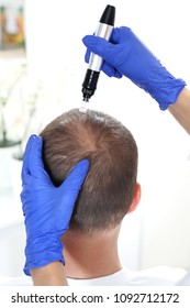 Mikronädische Mesotherapie der Kopfhaut. Der Kopf eines Mannes mit dünnndem Haar während der Nadelmesotherapie