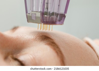 Microneedle mesotherapy. Woman receiving micro needling rejuvenation treatment in a cosmetology clinic. - Shutterstock ID 2186121035