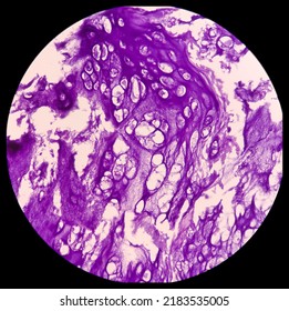 Microphotograph Of Bone Tumor, Enchondroma, Show Bony Tissue Features Of Enchondroma,Benign Bone Tumor.