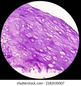 Microphotograph Of Bone Tumor, Enchondroma, Show Bony Tissue Features Of Enchondroma,Benign Bone Tumor.