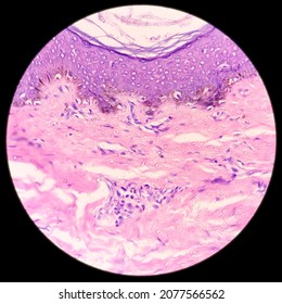 Microphotograph Of Keloid In Ear Lobe, Show Skin, Subepithelial Tissue Shows Haphazard Arrangement Of Collagen And Infiltration Of Inflammatory Cells