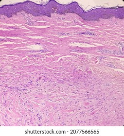 Microphotograph Of Keloid In Ear Lobe, Show Skin, Subepithelial Tissue Shows Haphazard Arrangement Of Collagen And Infiltration Of Inflammatory Cells