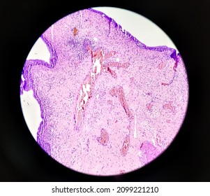 Microphotograph Of Keloid In Ear Lobe, Show Skin, Subepithelial Tissue Shows Haphazard Arrangement Of Collagen And Infiltration Of Inflammatory Cells