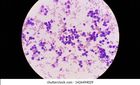 Microscope Slide Of Acute Leukemia