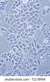 Microscope View Of Ductal Breast Cancer Cells In Tissue Culture Showing Walls, Nucleus And Organelles.