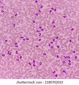 Microscopic Finding, Neutrophilic Leukocytosis, Increase Total Count Of White Blood Cell And Increase Number Of Neutrophils.