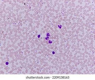 Microscopic Finding, Neutrophilic Leukocytosis, Increase Total Count Of White Blood Cell And Increase Number Of Neutrophils