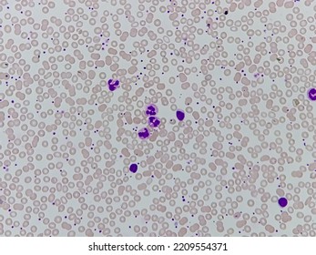 Microscopic Finding, Neutrophilic Leukocytosis, Increase Total Count Of White Blood Cell And Increase Number Of Neutrophils