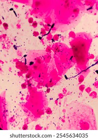microscopic of gram stain from sputum sample. abundant mix of  gram negative, gram positive and yeast, pseudo hyphae, pus cells, epithelial 