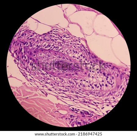 Microscopic image of back skin tissue, Pemphigus vulgaris, smear show suprabasal acantholysis. Intraepidermal vesicles with round acantholytic keratinocytes.