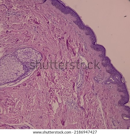 Microscopic image of back skin tissue, Pemphigus vulgaris, smear show suprabasal acantholysis. Intraepidermal vesicles with round acantholytic keratinocytes.