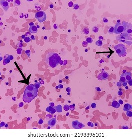 Microscopic Image Of Bone Marrow. Plasma Cell Dyscrasia Or Multiple Myeloma. A Type Of Bone Marrow Cancer Of Malignant Plasma Cells.