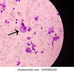 Microscopic Image Of Bone Marrow. Plasma Cell Dyscrasia Or Multiple Myeloma. A Type Of Bone Marrow Cancer Of Malignant Plasma Cells.