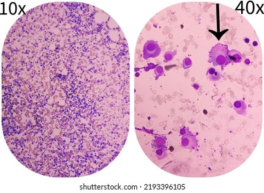 Microscopic Image Of Bone Marrow. Plasma Cell Dyscrasia Or Multiple Myeloma. A Type Of Bone Marrow Cancer Of Malignant Plasma Cells.