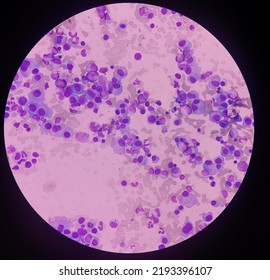 Microscopic Image Of Bone Marrow. Plasma Cell Dyscrasia Or Multiple Myeloma. A Type Of Bone Marrow Cancer Of Malignant Plasma Cells.